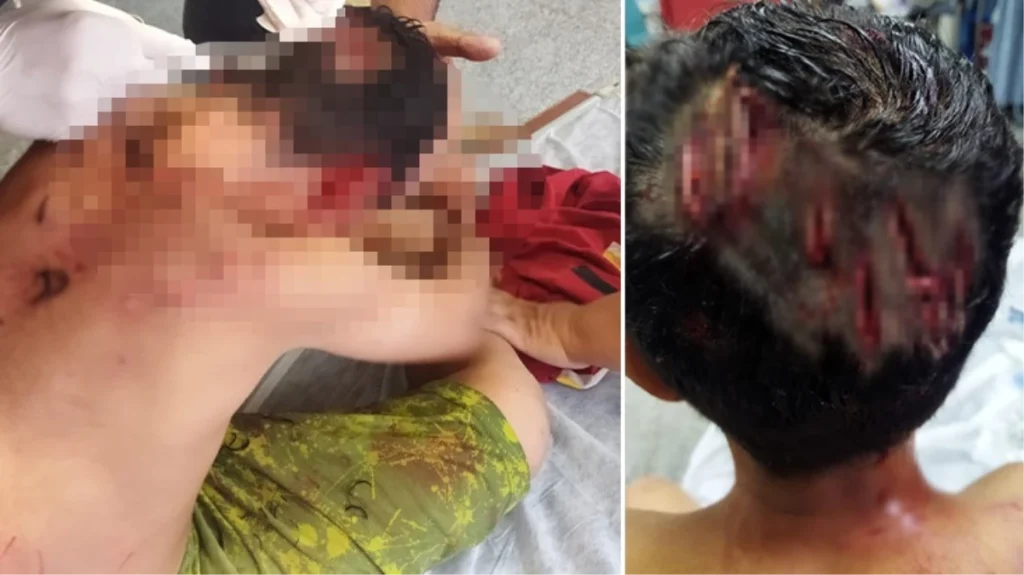Gaziantep’te köpeğin saldırdığı çocuk ölümden döndü! Kafasına 25 dikiş atıldı
