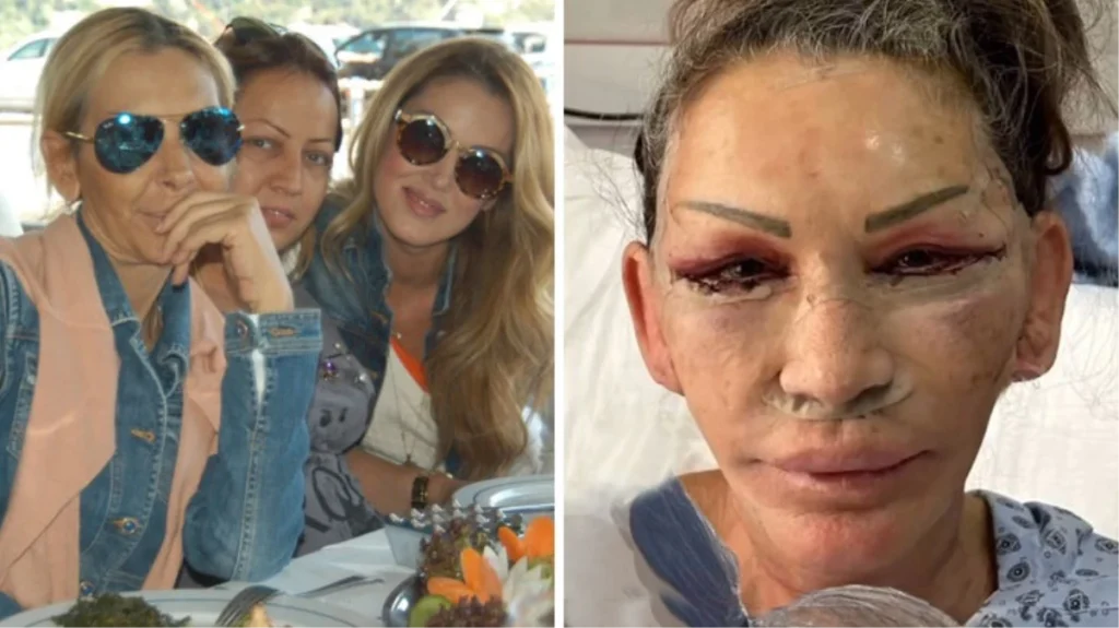Petek Dinçöz’ün annesi yüz gerdirme ameliyatı oldu! Yeni hali kızını solladı