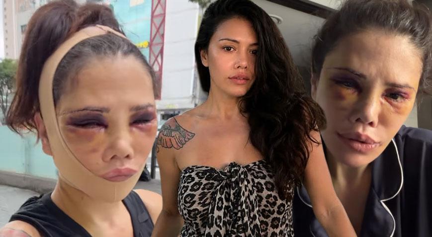 Didem Ceran’dan Yeni Ameliyat Açıklaması: “Yeniden Operasyona Girmem Gerekecek”