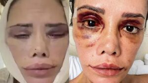 Didem Ceran ameliyat sonrası son halini paylaştı: “Beni merak edenlere iyi olduğumu göstermek istedim”